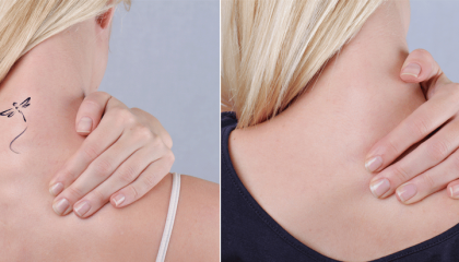 Does Laser Tattoo Removal Really Work