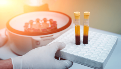 Prp Injection For Acne Scars