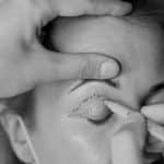 Blepharoplasty-parent