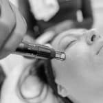 Laser Skin Resurfacing