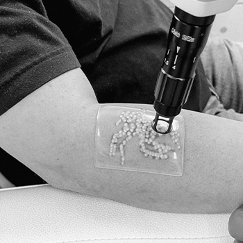 Tattoo removal