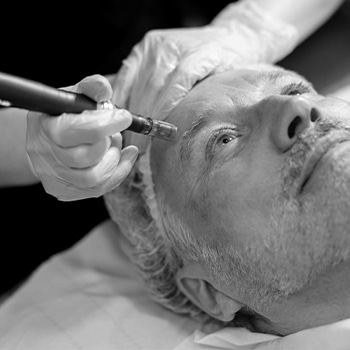 Microneedling