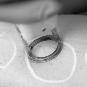 Vein Removal