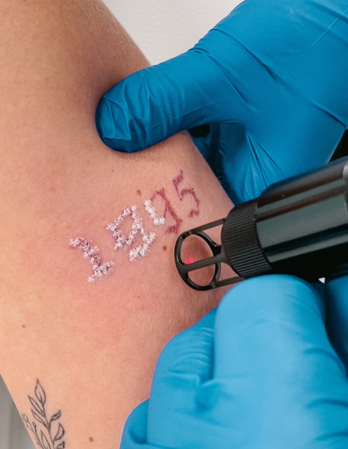 Laser Tattoo Removal