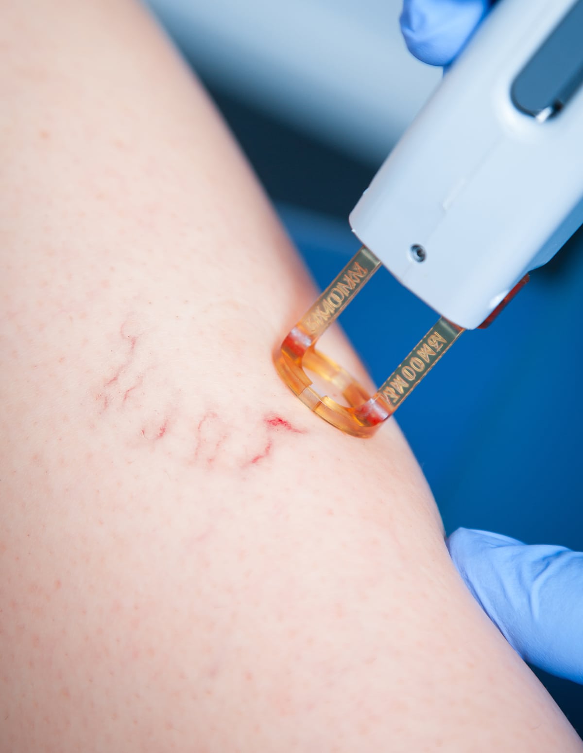 Tattoo removing