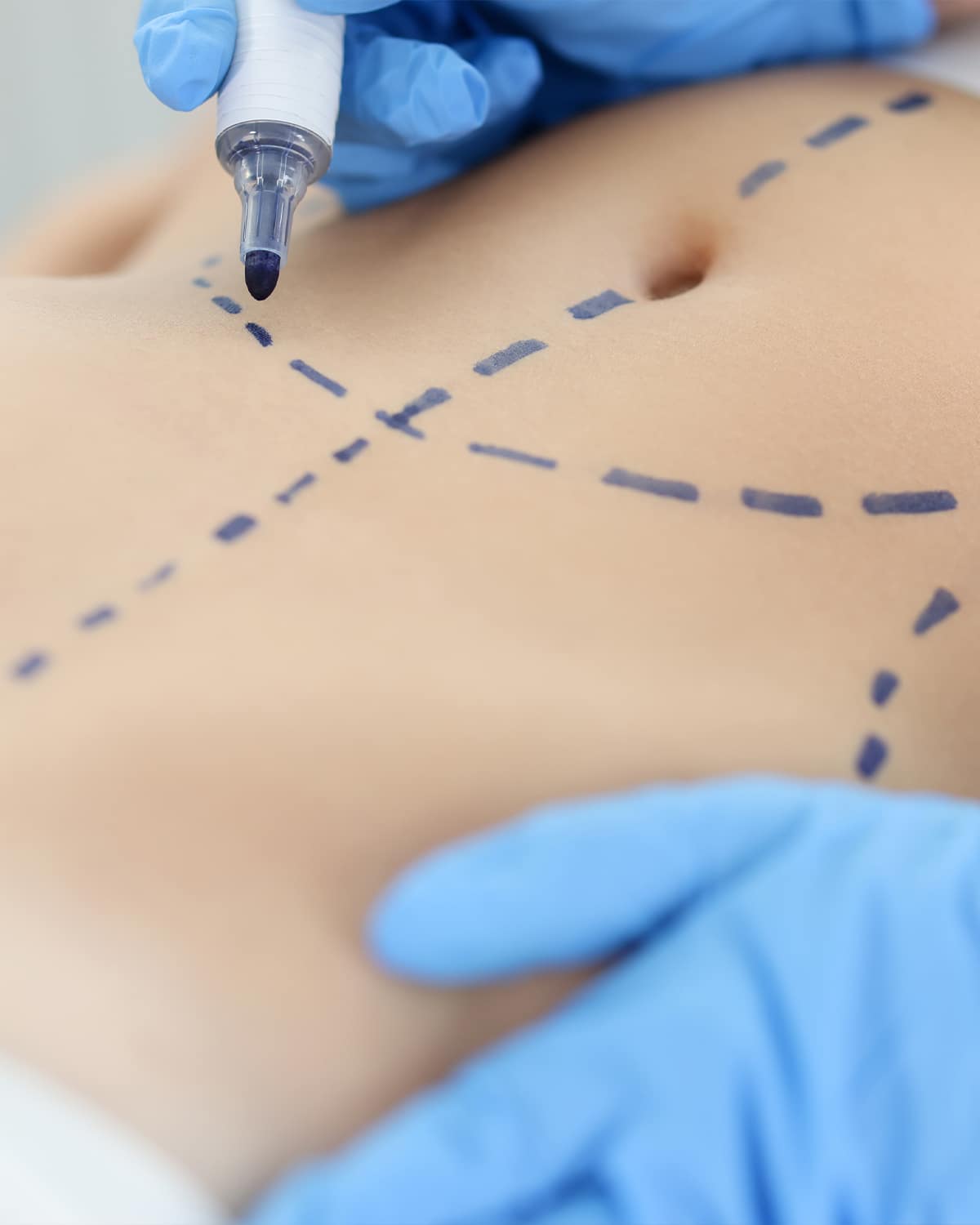 Liposuction