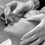 Microneedling Treatment