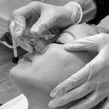 Microneedling treatment