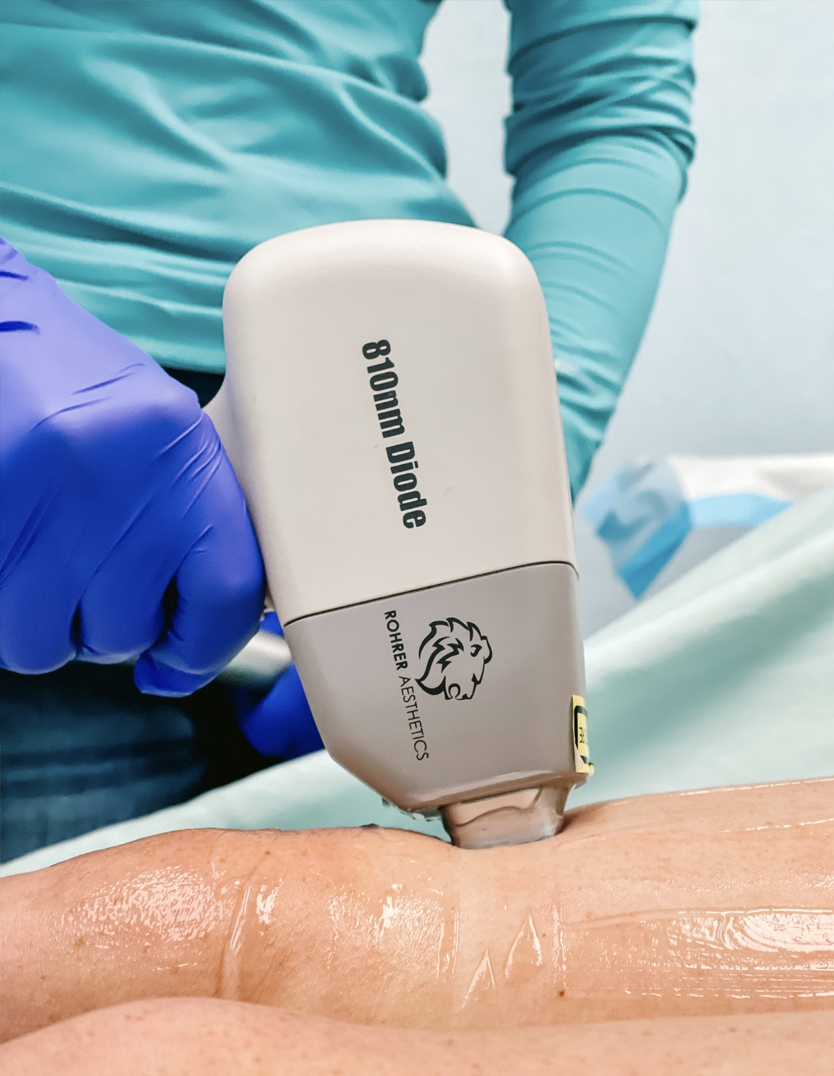 Laser hair removal