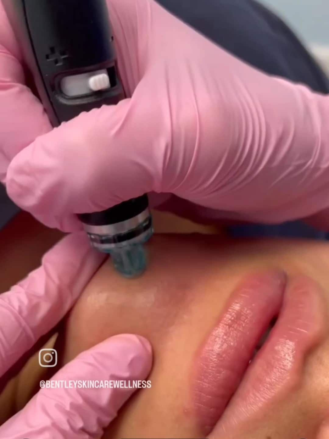 hydrafacial